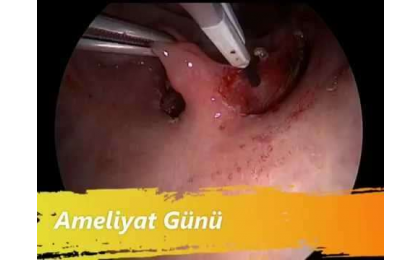 anterior-palatoplasti-horlama-ameliyati