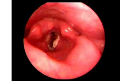 ses-teli-kanseri-cem-erdurak